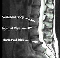 disc mri lower bulging herniated spine pain discs spinal lumbar does look low stenosis bulge ct condition arthritis imaging feel