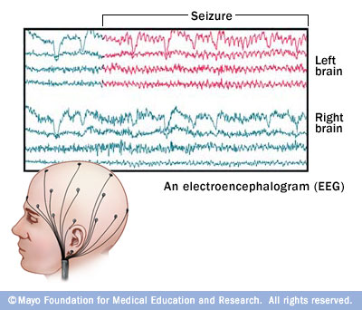 Healthy Life: EEG (electroencephalogram)