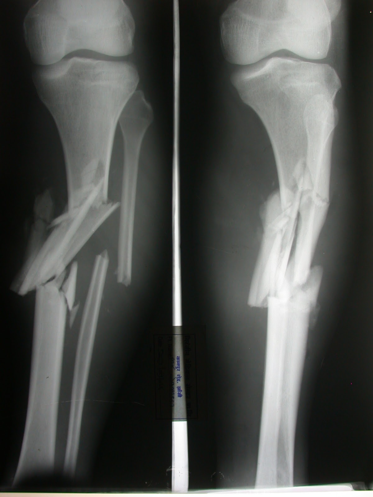 Understanding The Different Types Of Bone Fractures C Vrogue Co