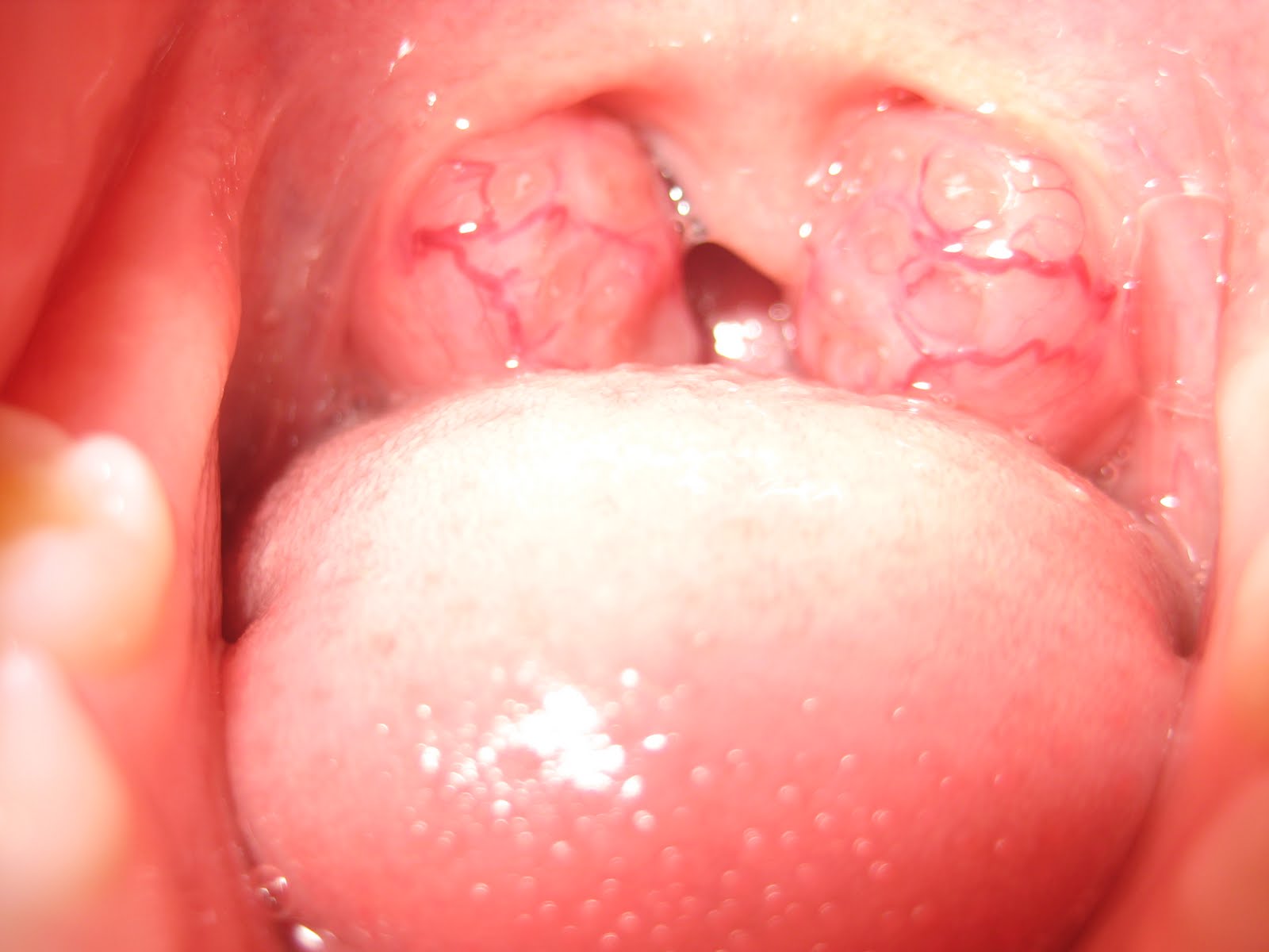 Red Veins In Throat 16