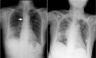 ensanchamiento mediastinal