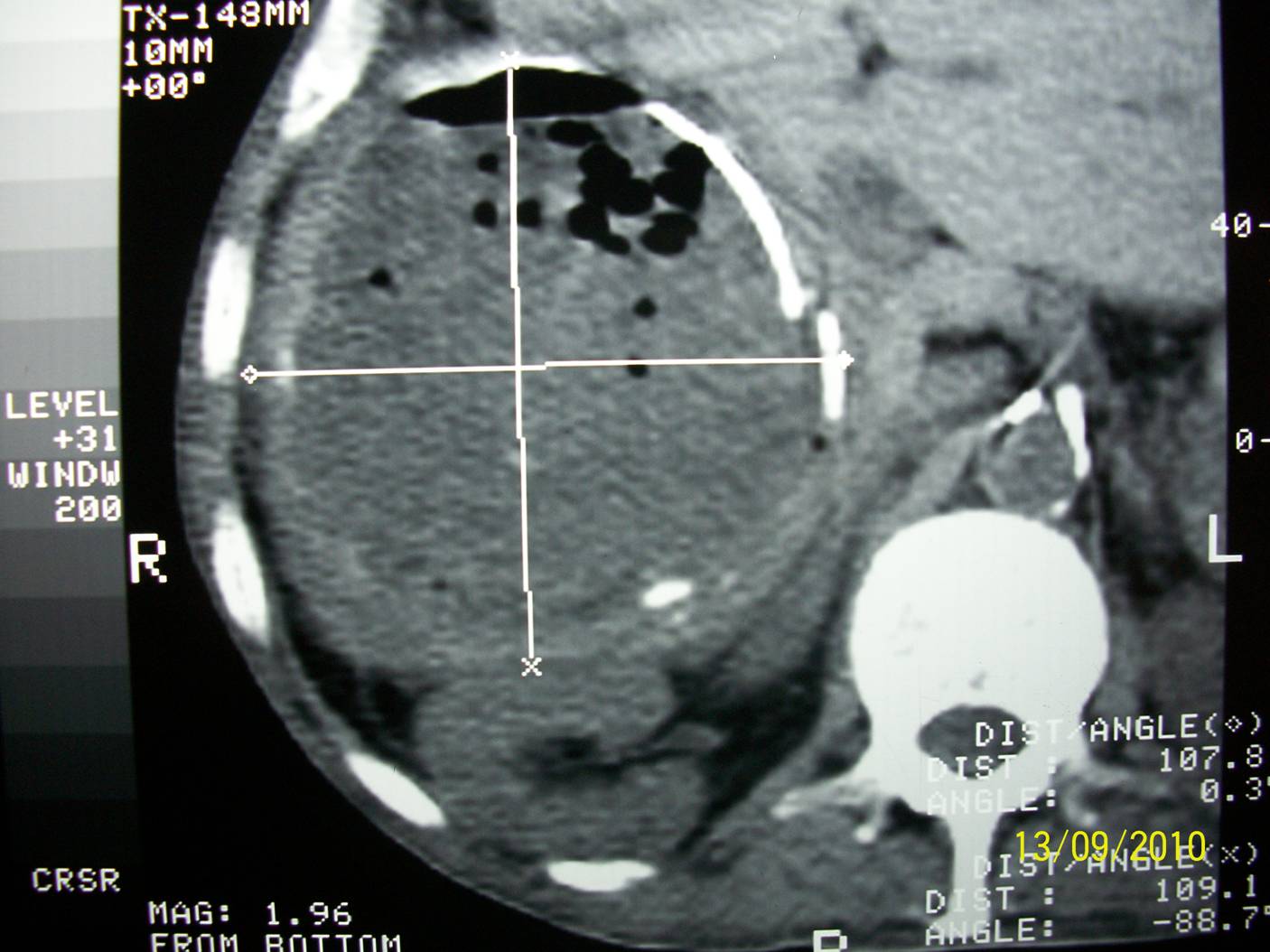 Quiste hepatico simple complicado