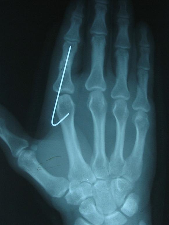Трещина фаланги. Перелом 2 пястной кости. Рентген перелома средней, фаланги мизинца руки. Рентген 5 пястной кости.