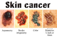 About Chemistry: Skin cancer, non-melanoma
