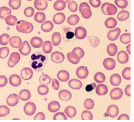 Cooley's Anemia