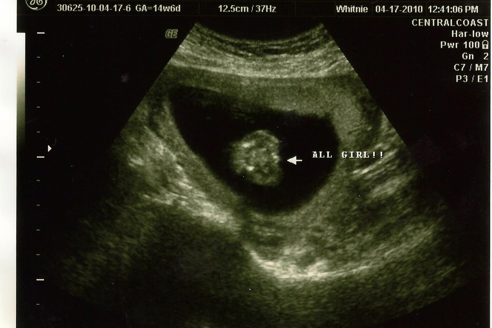 Ultrasound Sex Baby 97