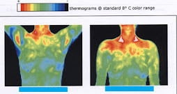 Permanent thermoregulatory Dysfunction after Sympathectomy