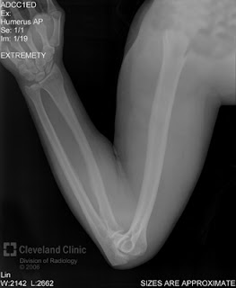 Thats The Bone In Your Upper Arm Get It Humerus Humorous Pretty Funny Huh Heres An X Ray Of The Humerus Thats The Bone In Your Upper Arm Get It Humerus Humorous Pretty Funny Huh Heres An X Ray Of The Humerus