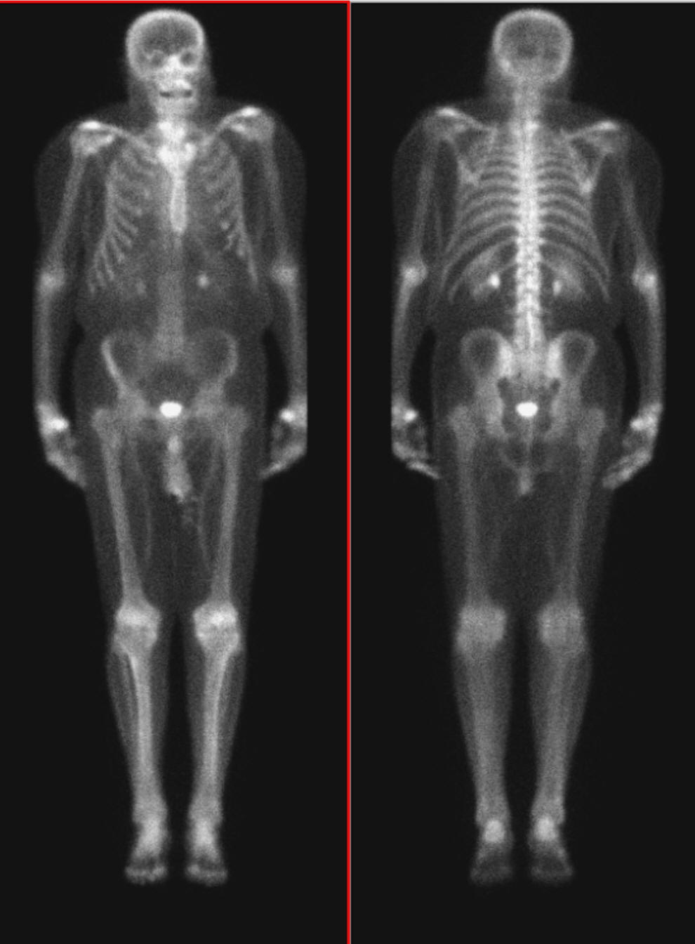 Обследование скелета костей. Радиоизотопное сканирование костей. Остеосцинтиграфия костей скелета норма. Сцинтиграфия скелета (остеосцинтиграфия). Процедура проверки костей при онкологии.