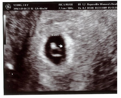 AKPWEHKG: ultrasounds at 6 weeks