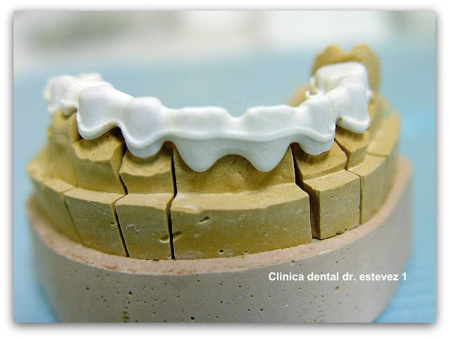 Clínica Dental Dr. Estévez: ¿Qué es el CAD/CAM?