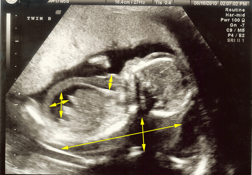 Making Babies (and making dinner when possible) Pictures of the twins