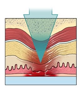 механизм пролежней