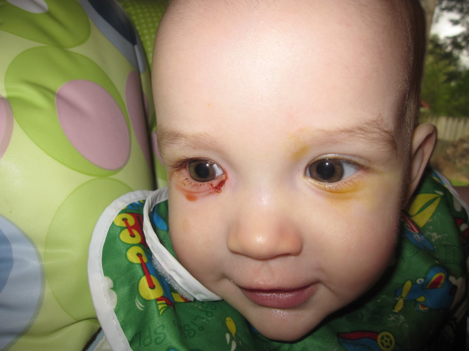 Oh, My Soul Rejoice! Nasolacrimal Duct Obstruction (blocked tear duct)