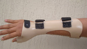 Wrist hand orthosis for Scaphoid fracture