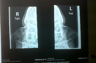 nose broken bone septum xray bones spot august dislocated apparently worse having because than which