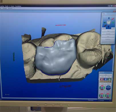 CAD software sculpting dental crown