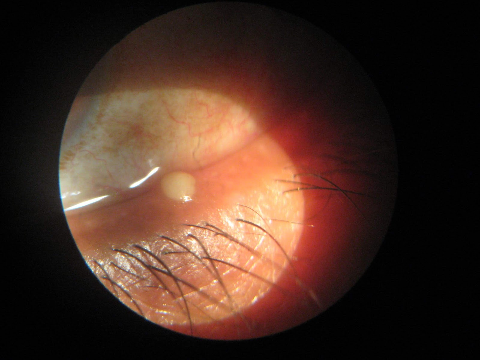 Keratoconus Surgery Ring Gambar FGH