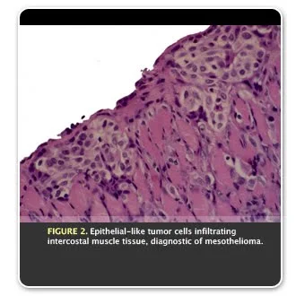 Artistic Mesothelioma Versus Adenocarcinoma Picture Photography Artistic Mesothelioma Versus Adenocarcinoma Picture Photography