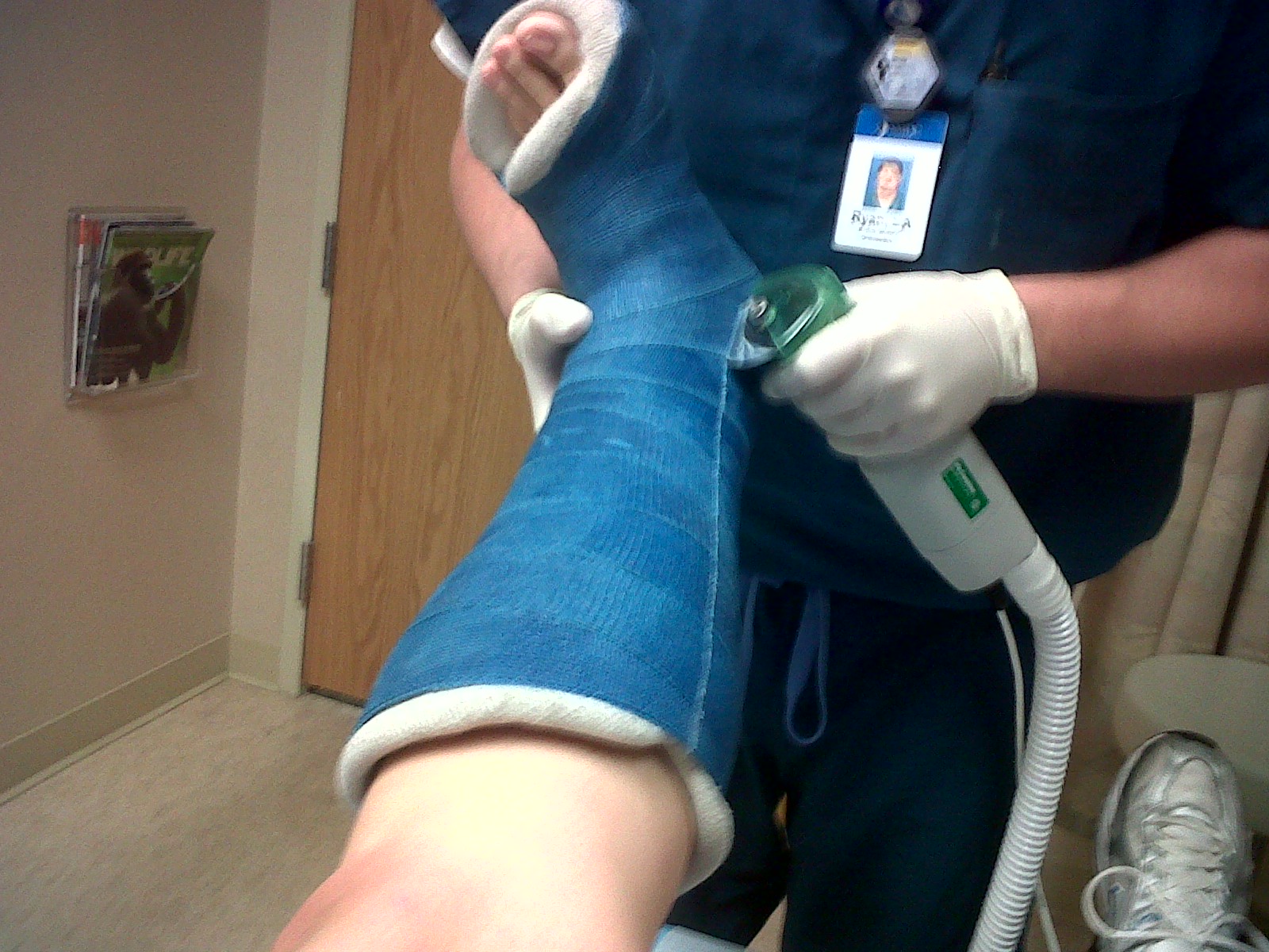 Wanna talk about it?: Day 61 post op. Cast removal day!