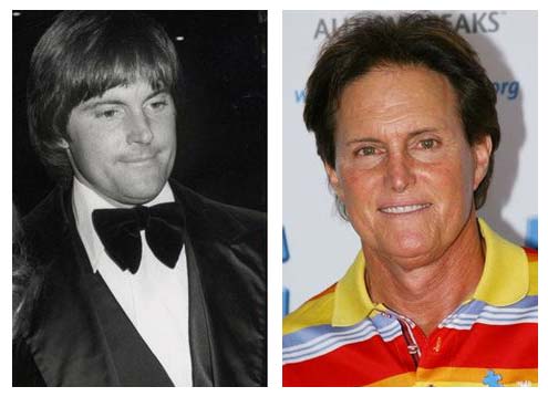 Plastic Surgery Before After: Bruce Jenner Plastic Surgery
