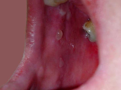 Oral Cancer Photo