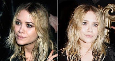Mary Kate Olsen Awful Plastic Surgery