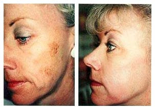 Microdermabrasion Before And After