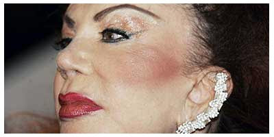 Plastic Surgery Before And After: Rhinoplasty Gone Wrong