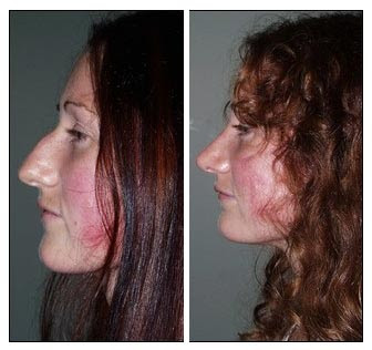Chin Implants Before And After