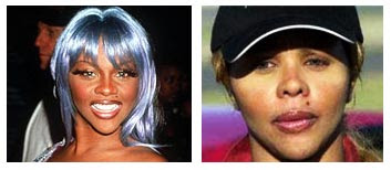 Lil Kim Before And After Surgery