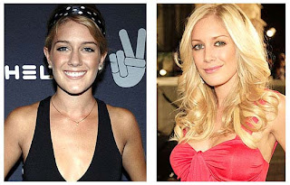 Heidi Montag Plastic Surgery Before And After
