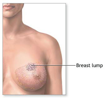 Lump Under Nipple 114