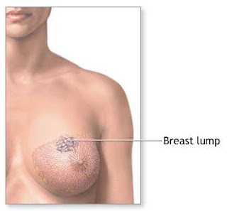 Breast Cancer Lump