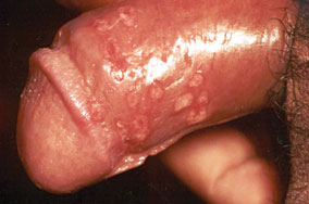 sifilis+primer+pada+penis.jpg