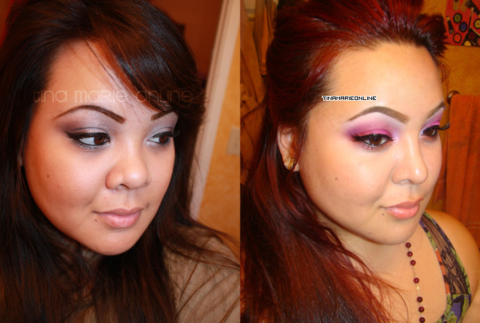 Nose Job Before And After (Rhinoplasty)