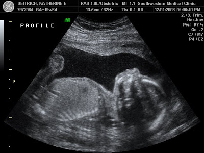 Katie Deitrich: Latest Ultrasound at 20 weeks-It's a boy!