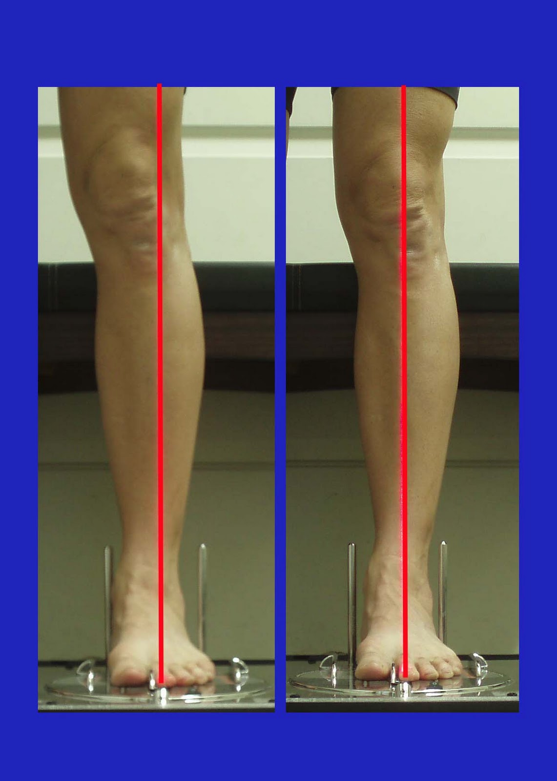 knee ankle foot alignment normal alignement abnormal correct vs left bike