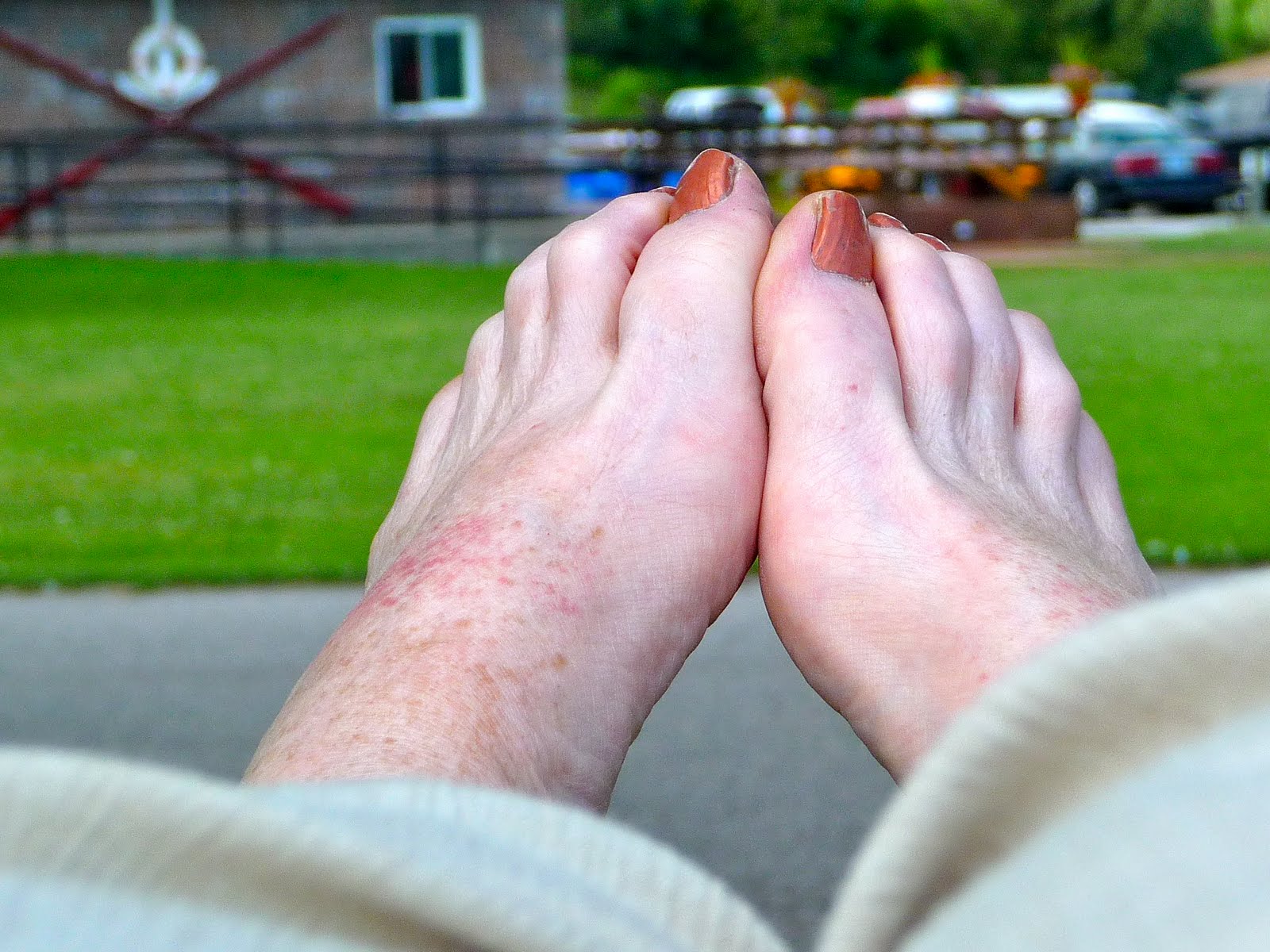 heat rash on foot pictures #10