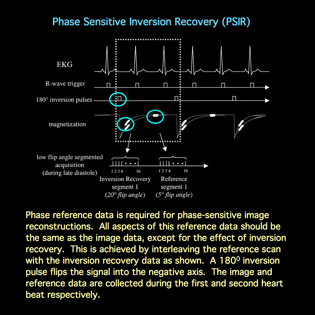 Mri Blog Phase Sensitive Inversion Recovery