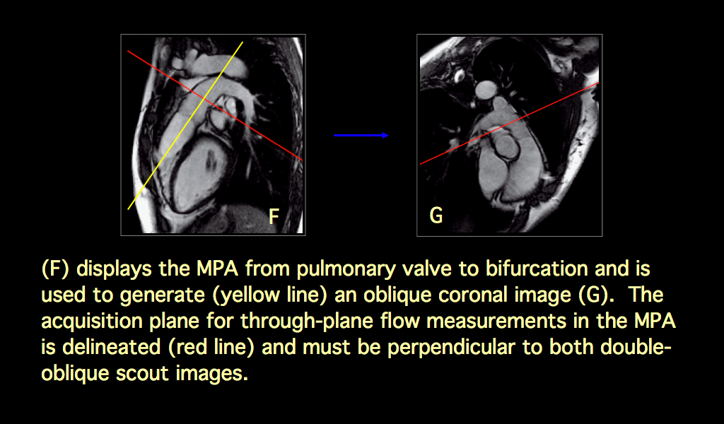 MRI BLOG Flow Measurement in Main Pulmonary Artery