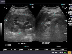 hydronephrosis mild ultrasound grades imaging