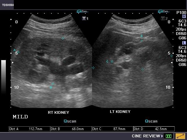 On Radiology Grades Of Hydronephrosis On Ultrasound Imaging