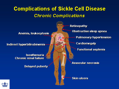 Doctors Gates: Complications of Sickle cell disease