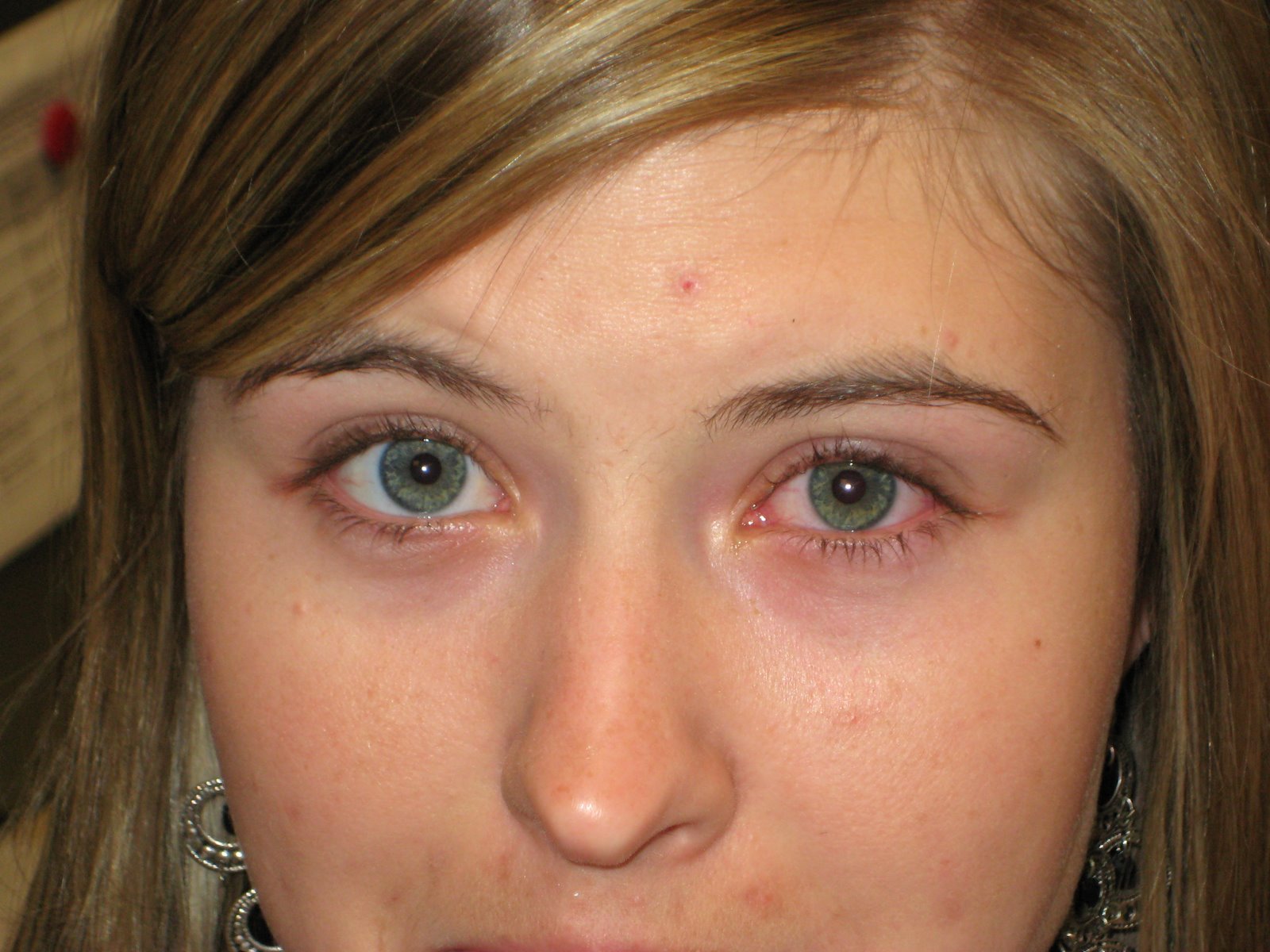 Conjunctivitis Images - Photos - Pictures - CrystalGraphics