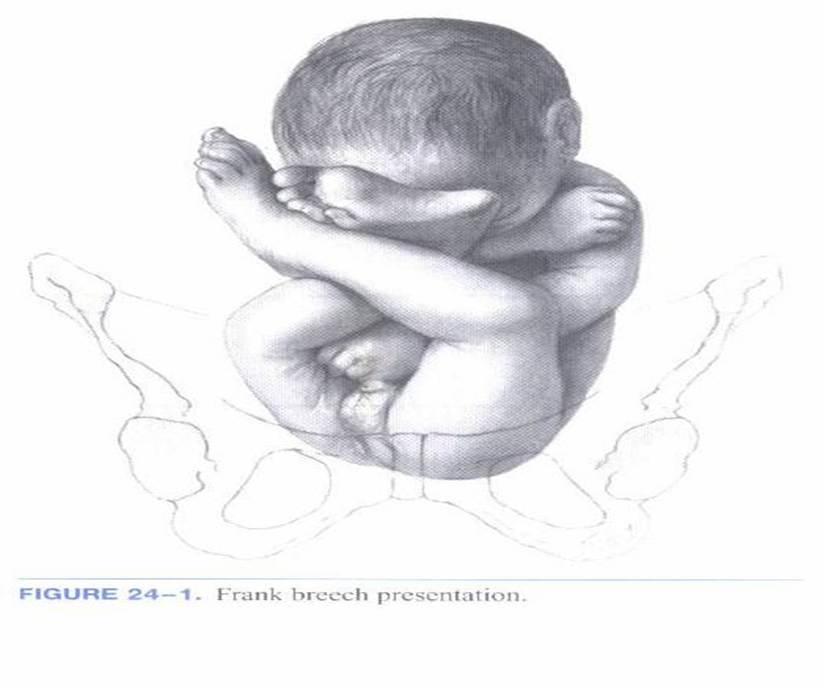 MEDICAL IMAGES Extended breech