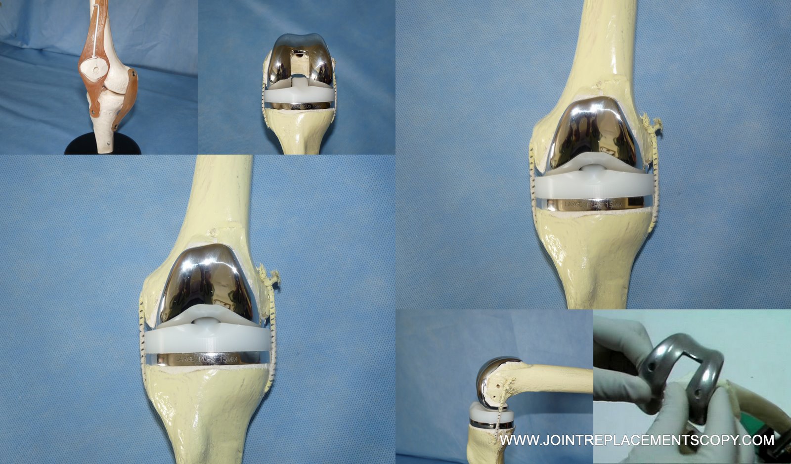 Jointreplacementscopy Knee joint replacement