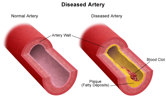 Arter Deadflow My beating heart: The changes in artery structure associated with ...