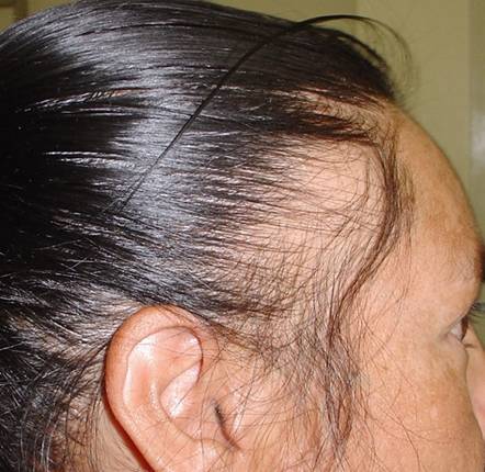 Traction Alopecia, Growing back? | WomenHG