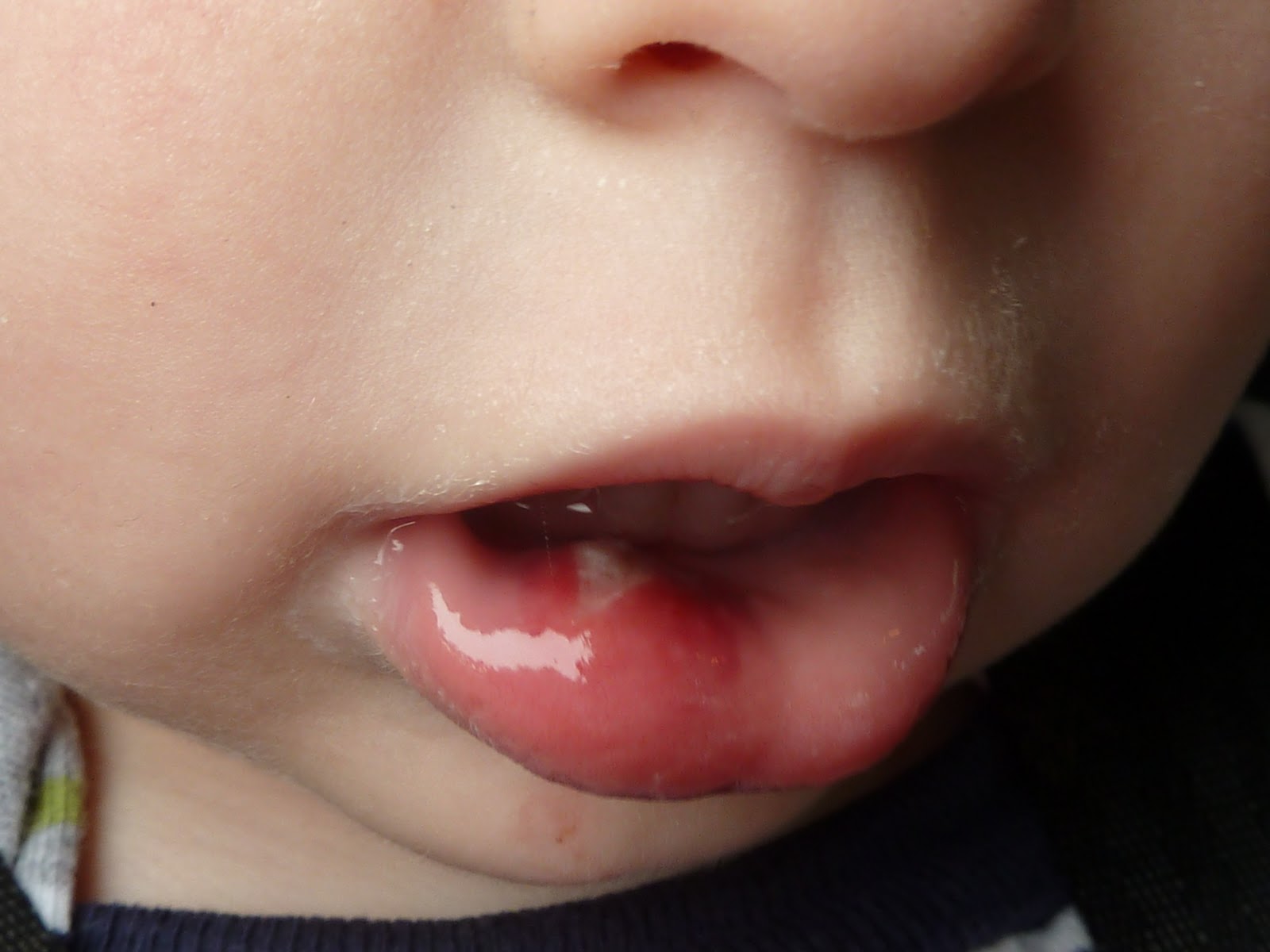 The Vandervort Family Blog Busted Lip. No joke.